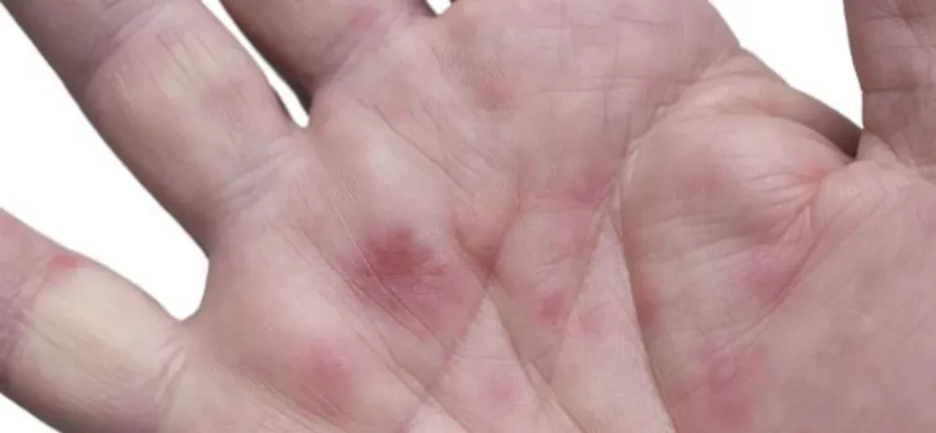 9種肝病症狀出現的身體警訊!肝臟健不健康一看就知道!