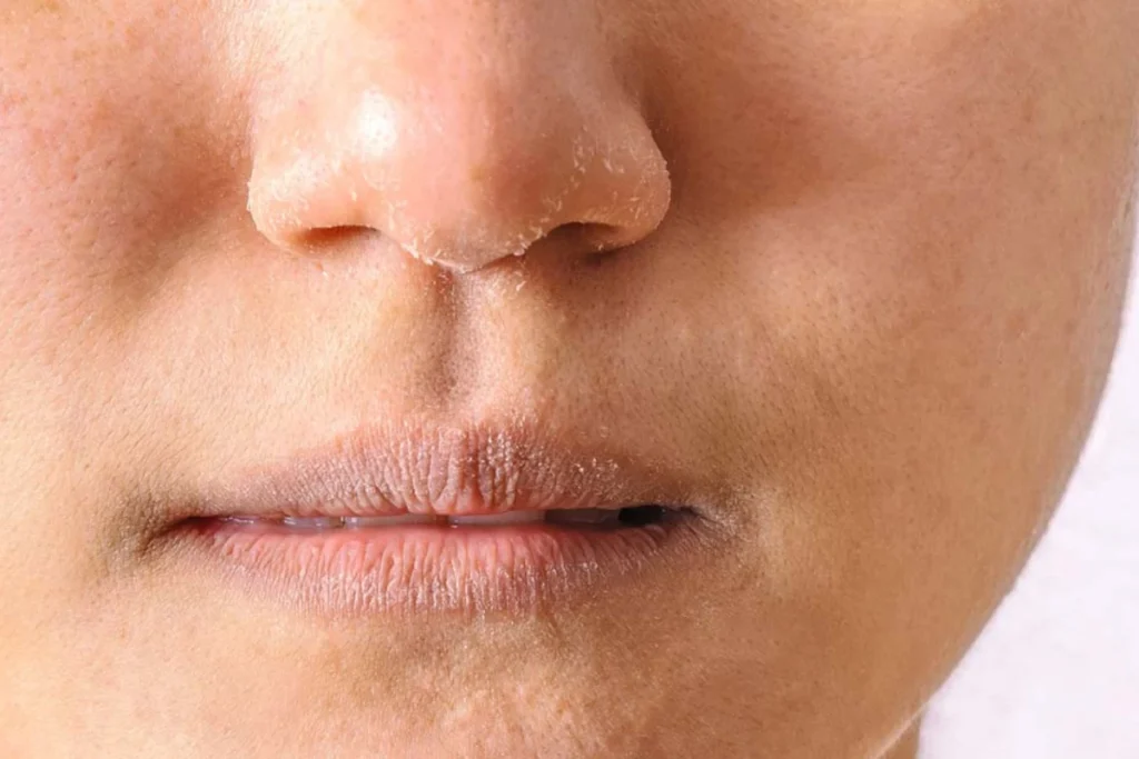 乾燥型毛孔粗大是一種視覺現象，嚴重時鼻翼或雙頰可能脫皮