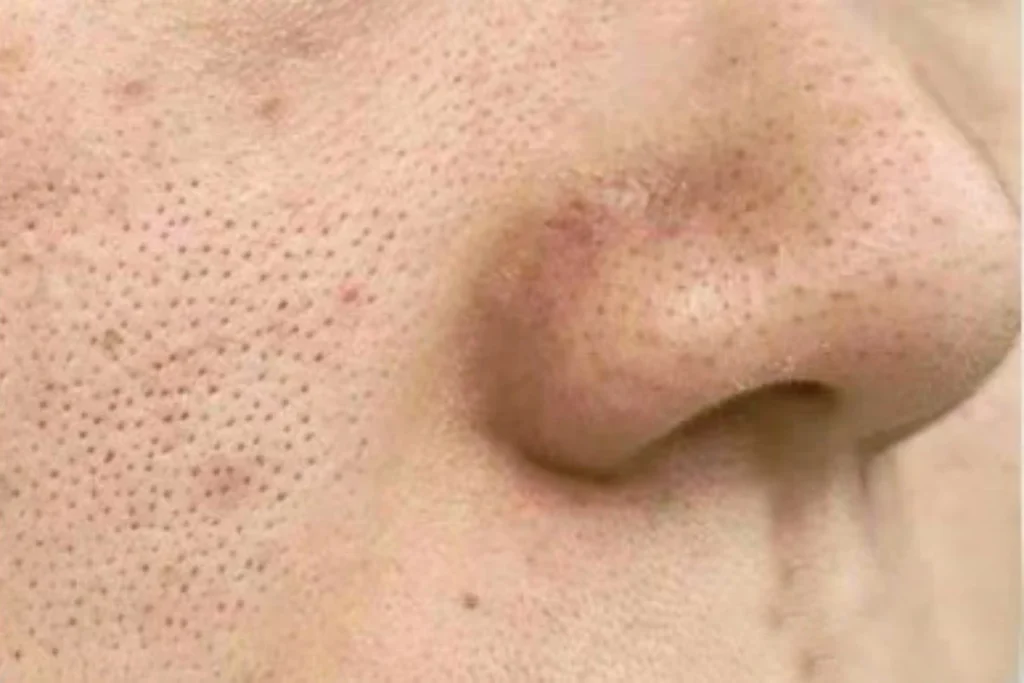 角質型毛孔不論乾皮或油皮都可能發生，主要原因是異常增生堵塞