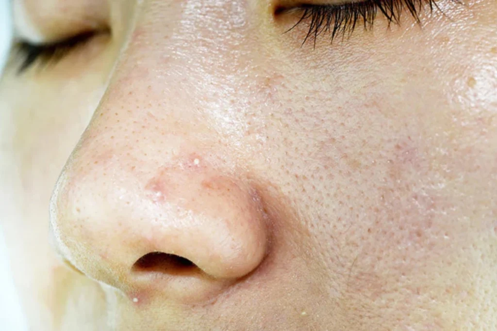 油脂型毛孔粗大好發於青少年和油性皮膚族群