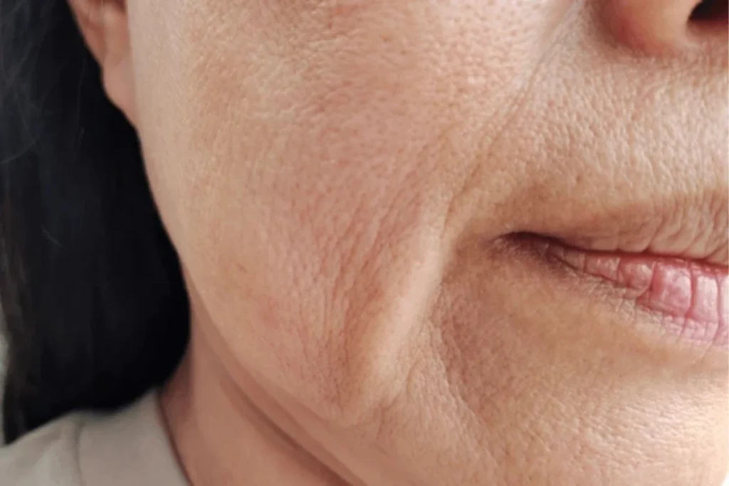 老化型毛孔毛孔粗大常伴隨皺紋、皮膚鬆垮等狀況