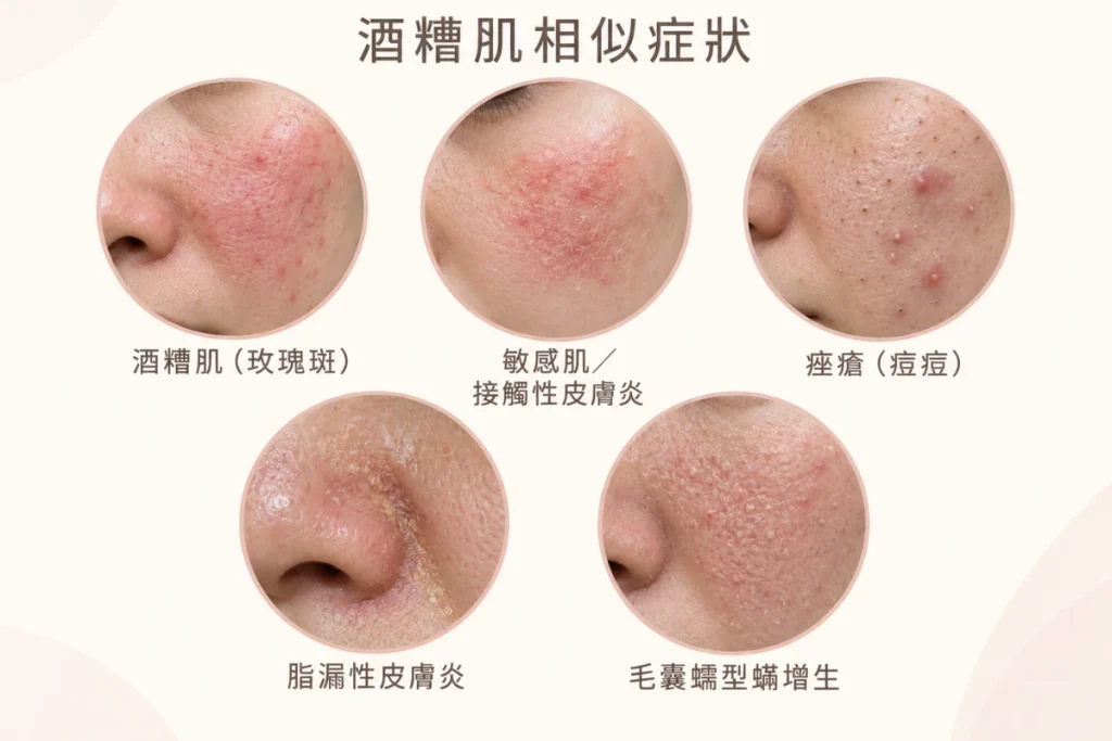 酒糟肌相似症狀