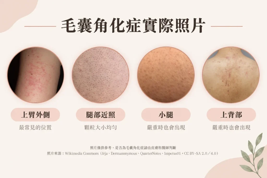 毛囊角化症是皮膚角質在毛囊開口處堆積，形成一顆顆小角栓