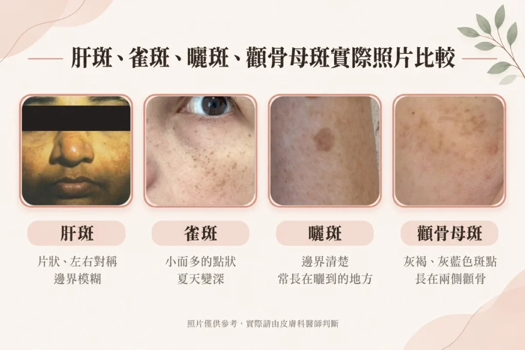 肝斑、曬斑、顴骨母斑和雀斑怎麼分