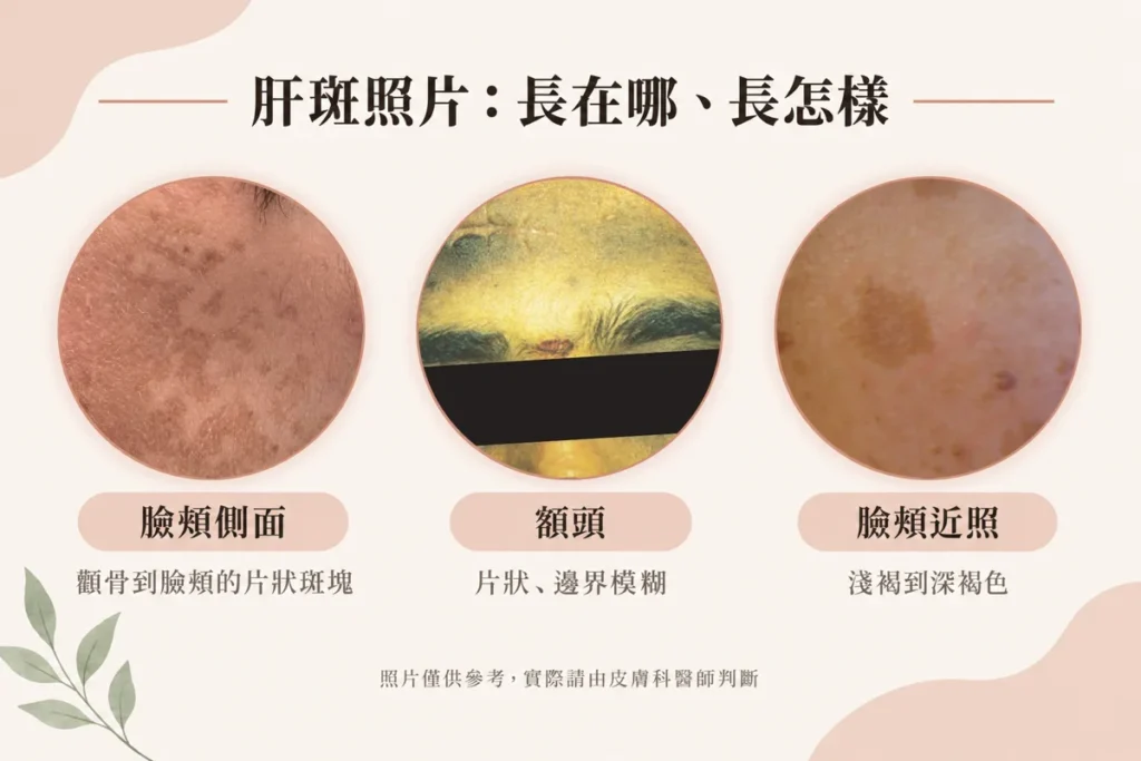 肝斑長怎樣？肝斑照片